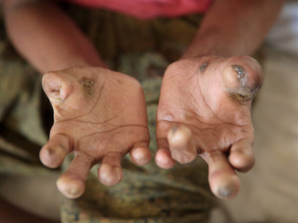 कुष्ठरोग