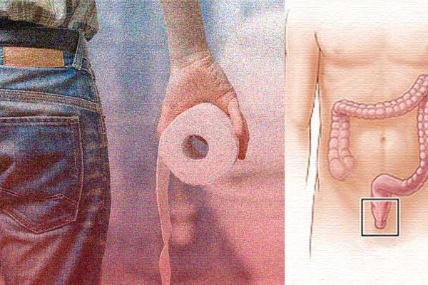 hemorrhoids