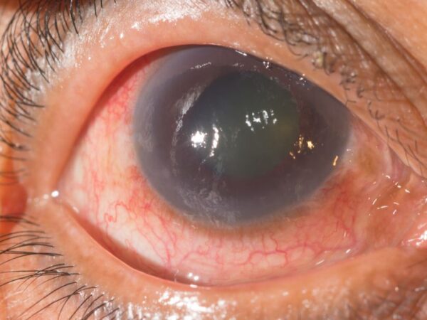 Glaucoma