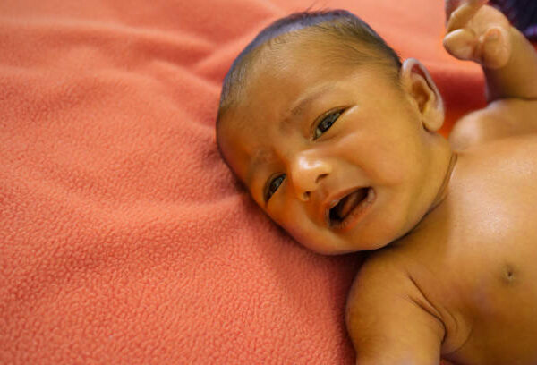 Kwashiorkor