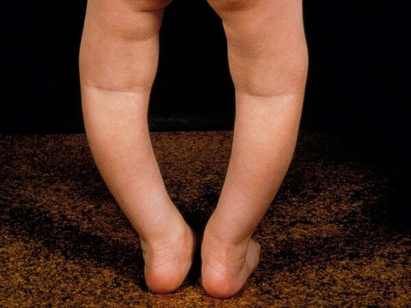 Vitamin D deficiency