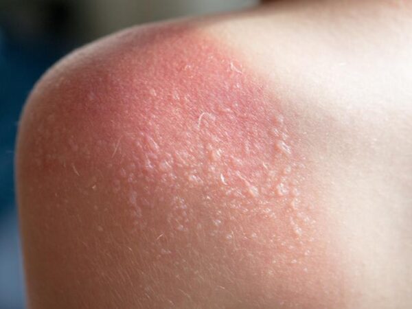 Rashes